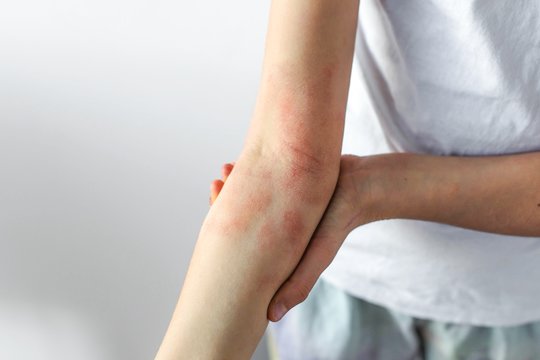 Atopinis dermatitas: nuo genetikos iki sauso oro – kas lemia ligos atsiradimą
