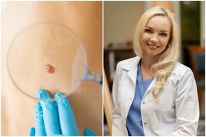 Vėžiui pastebėti – „bjauriojo ančiuko“ taisyklė: gydytoja prašo ją įsidėmėti