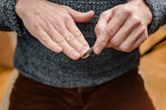 Trūksta vitaminų? Pasakė, ką iš tikrųjų reiškia balti taškeliai ant nagų